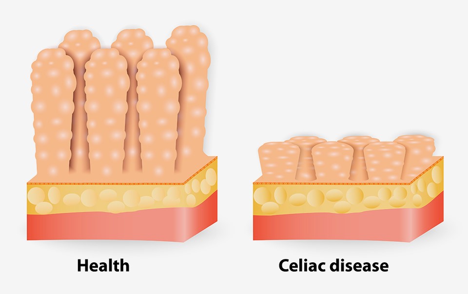 Coeliac Disease