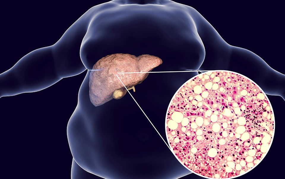 Non-alcoholic Fatty Liver Disease