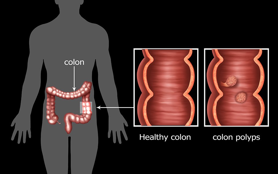 Colonic Polyps