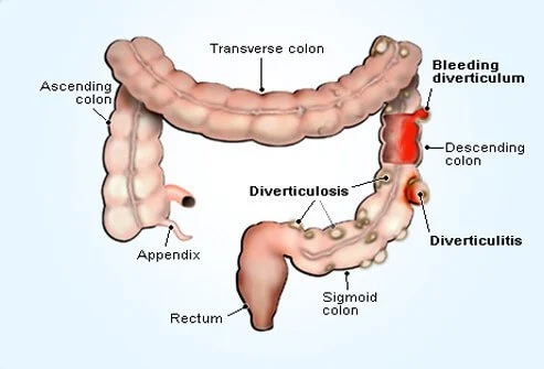 Diverticulitis