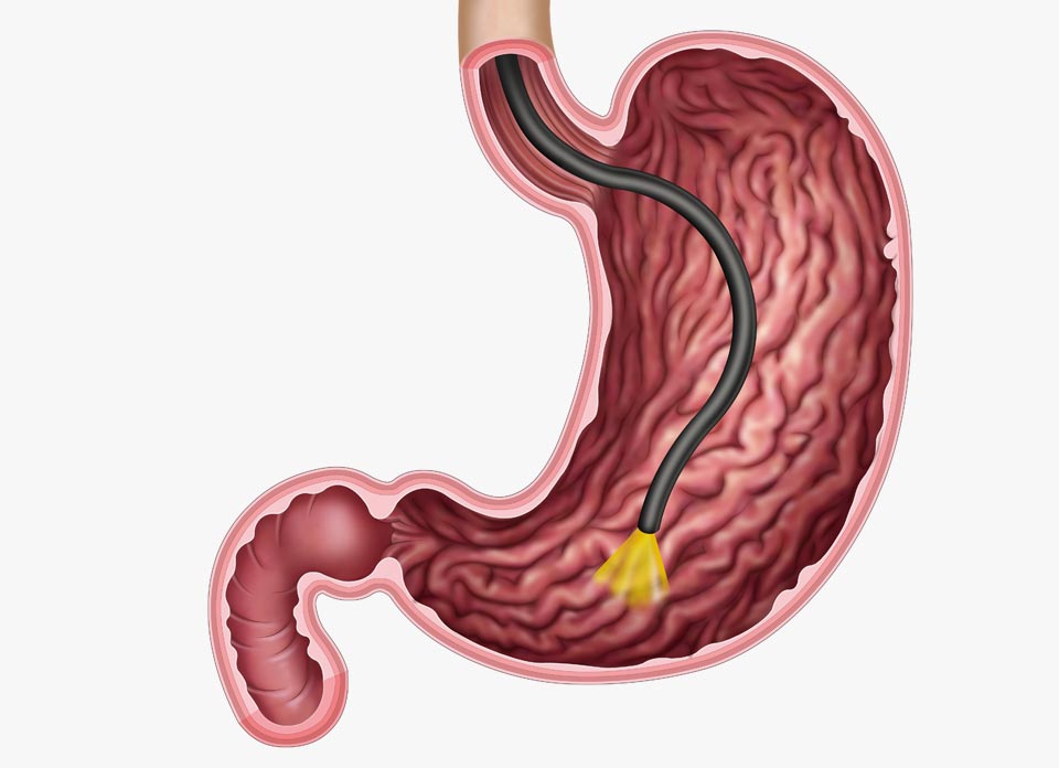 Gastroscopy Diagram