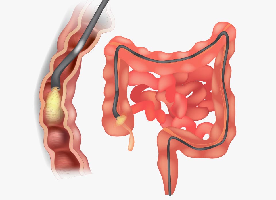 Colonoscopy diagram